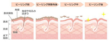 ケミカルピーリング説明図