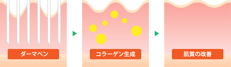 ダーマペン図解