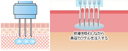 水光注射説明図